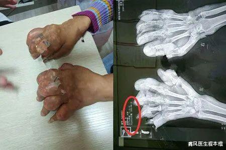 木耳|超微创取痛风石-足足70g的痛风石被取出来