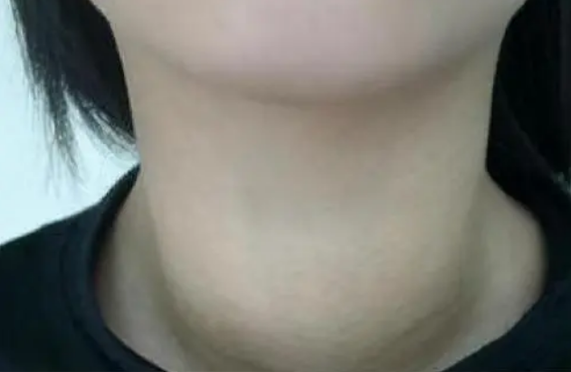 甲状腺癌|乳甲科医生提醒：1“绞肉机”或是甲状腺癌的“加速器”，趁早丢