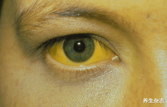 肝癌|34岁大哥,滴酒不沾,查出肝癌,医生:2种食物常吃,铁打的肝也扛不住