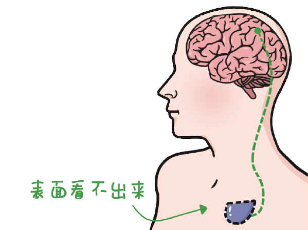 德济脑科|DBS治疗癫痫，需要注意哪些事项？