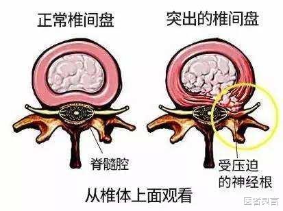 医者良言 腰间盘膨出导致腿疼，腿麻可以治愈吗，需要注意什么？