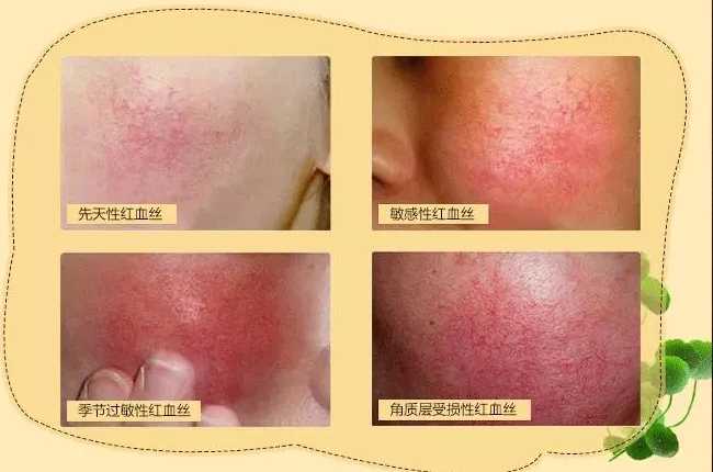 |鼻空下、两腮处是不是有红血丝？这个是怎么回事能去掉么？