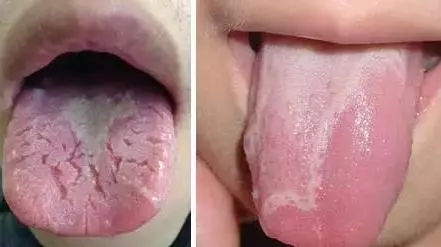 山楂|舌苔辨识9种中医体质，有配图！