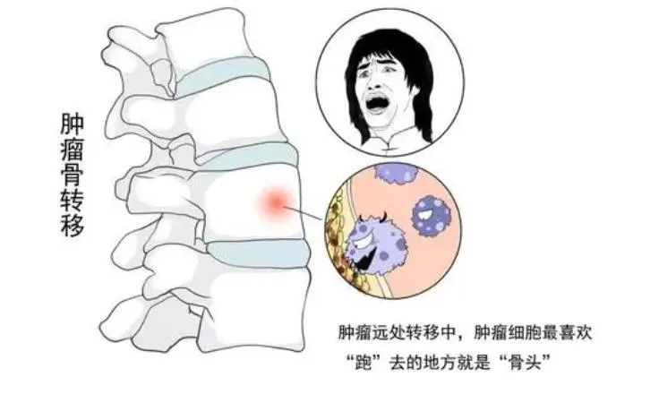 家属说|癌症骨转移前，身体会发出这些求救信号！尤其是“高危关键期”！