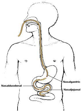 |通梗阻——解除粘连，让肠道恢复常态才是关键
