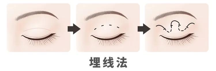 小美说美|割的双眼皮怎么才能看不出来