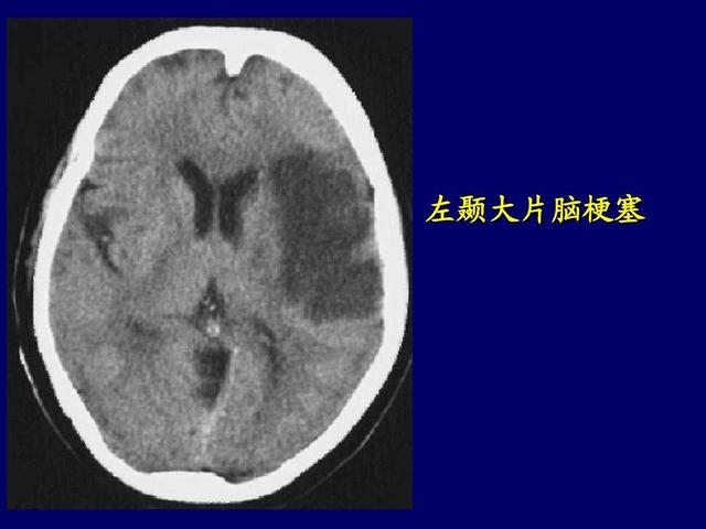 高血压|46岁女子，因“挑食”躲过脑梗？医生夸赞：这3物，幸亏你不爱吃