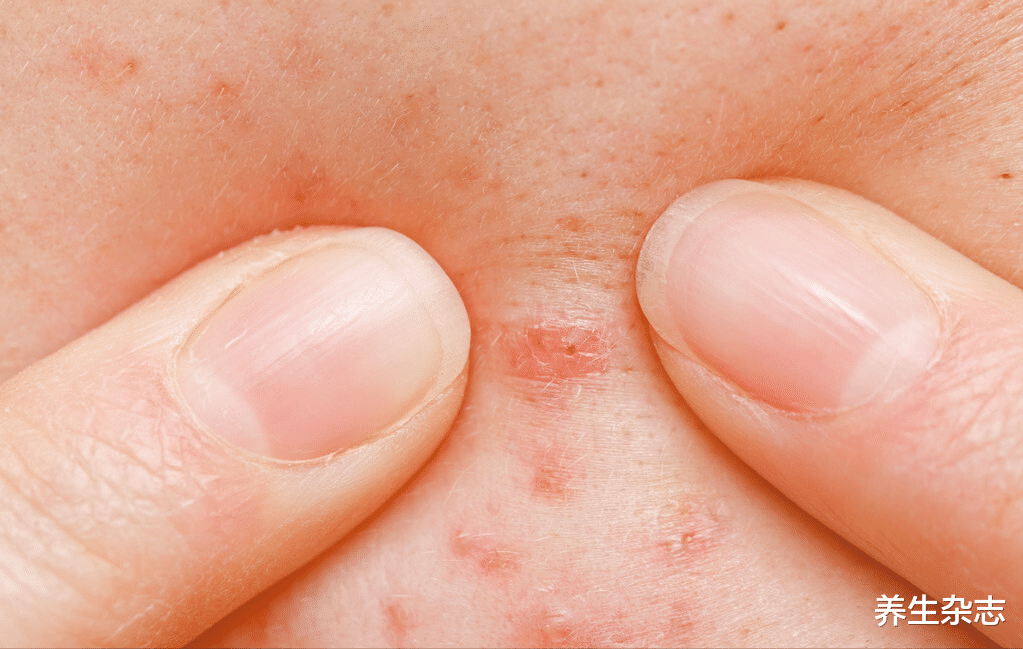 养生杂志|25岁,青春期早已经过了,还满脸长痘,该怎么办?