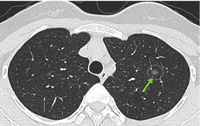 成都中医哮喘病医院|体检若发现肺结节怎么办?不要慌,大多数结节都是小问题