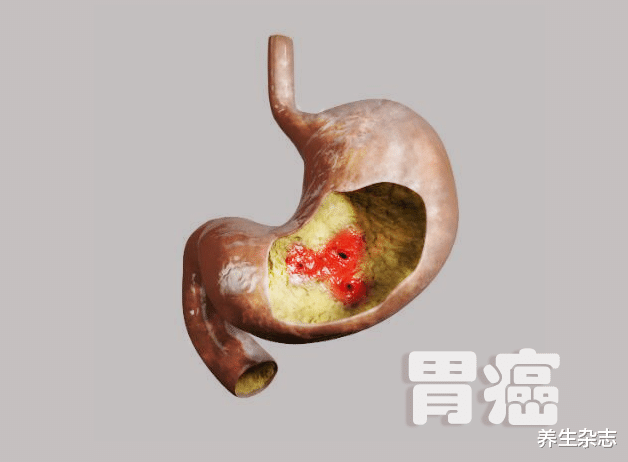 胃癌|“胃癌”一發現即晚期？提醒：飯后若有3異常，盡早做胃鏡，別拖