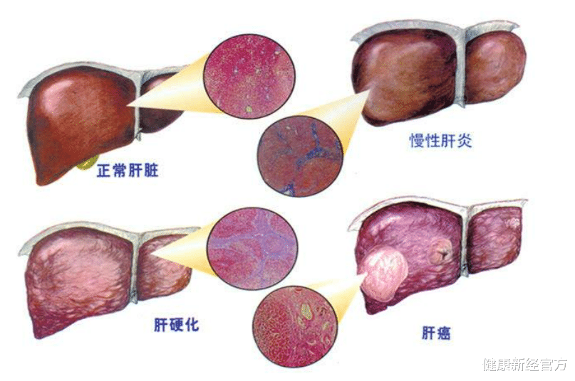 健康新经官方 肝病来临，舌头先知！专家提示，舌头3变化，八成是肝癌前兆，早做肝CT
