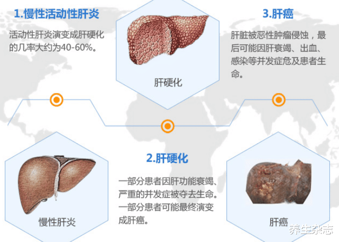 养生杂志|从“肝炎”到“肝癌”一般用多久？建议：3个致癌因素，尽量远离