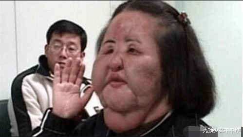 韓國女模特整容上癮失去理智，註射食用油毀容，面部醜陋異常-圖7