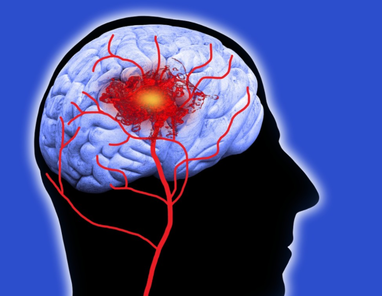 饮食|夫妻双双确诊脑梗，医生：炒菜爱放1物，血管迟早挨堵，尽快远离！