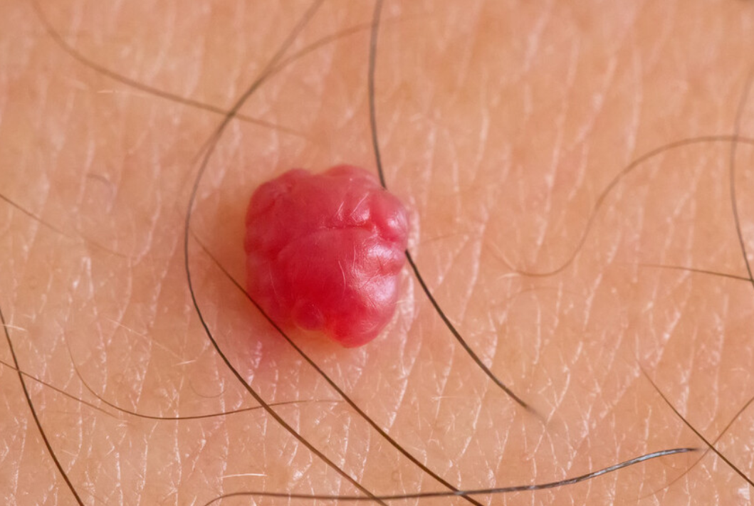 流鼻血|皮肤上有这3种变化，恭喜你被HPV“看上了”，做到这2事就能避免