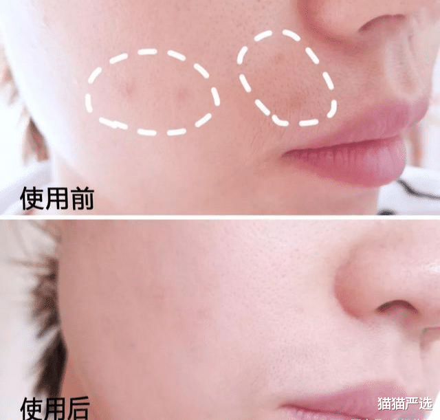 黑色素 还在走捷径打美容针？看看这些反面例子长点心吧！护肤这事急不得