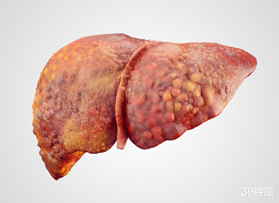 39肿瘤|肝病专家建议：1种“水”，平时经常喝，肝脏或许能慢慢变好