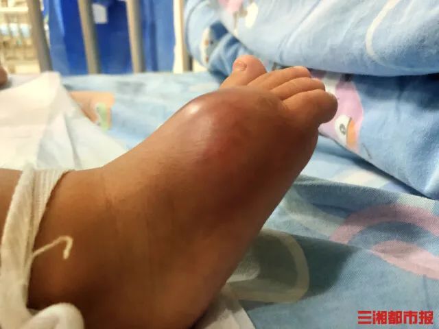 水稻 8个月宝宝进ICU,只因家长帮他挤了个脓包……