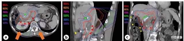 印塔健康|肝癌合并大血管侵犯：经碳离子放疗联合全身治疗（仑伐替尼）