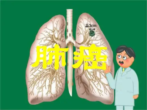 麦吉科普|为啥“肺癌”患病率这么高？除了吸烟，还有4个诱因，需要警惕