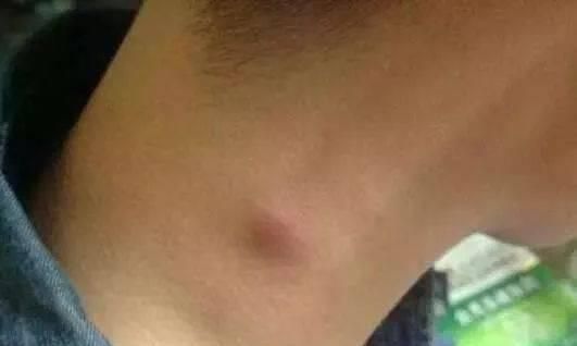 咳嗽|肺不好,会出现“1慢、2凸、3多”,对照自查,看看你占了几个?