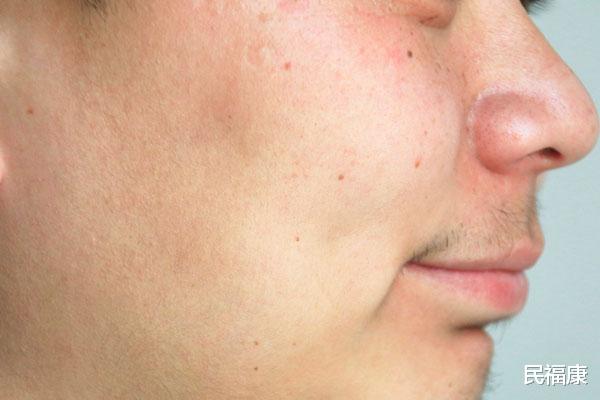 防晒|皮肤晒黑、长斑，和哪些因素有关？