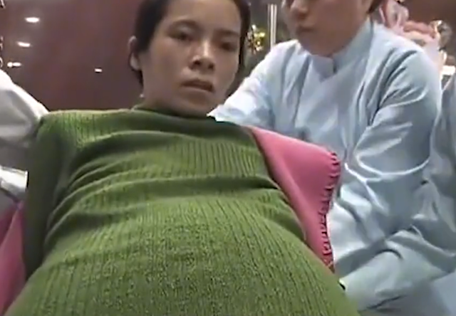 广东女人怀胎12个月未生,肚子大到50公斤,医生检查后说不可思议