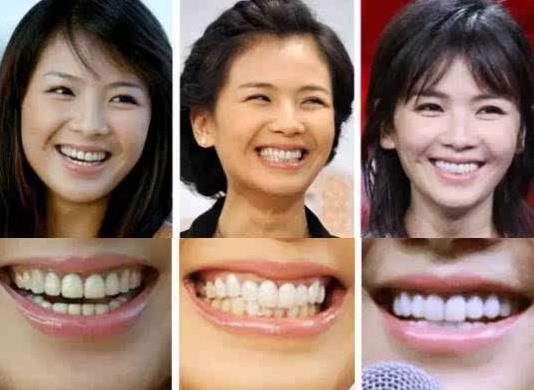 刘涛|明星“假牙”大pk：刘涛花300万整牙，吴昕的牙齿变黢黑