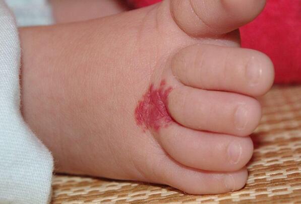 旧海拾荒|身上有胎记是不是病?竟然有些胎记还被认为是幸运的标志?