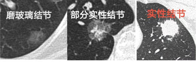 姚宏胤|发现肺结节怎么办