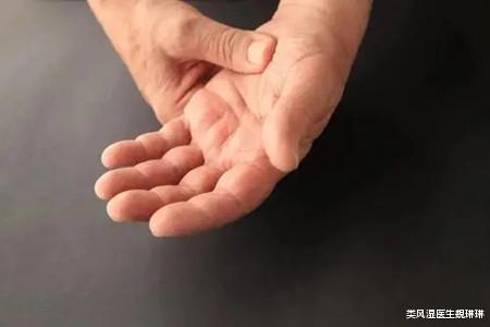 心房颤动|免疫力低下的类风湿患者在饮食上要注意什么?