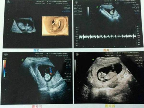 怀孕妈妈知识宝典|nt判断生男生女看两个重点，真的准吗？