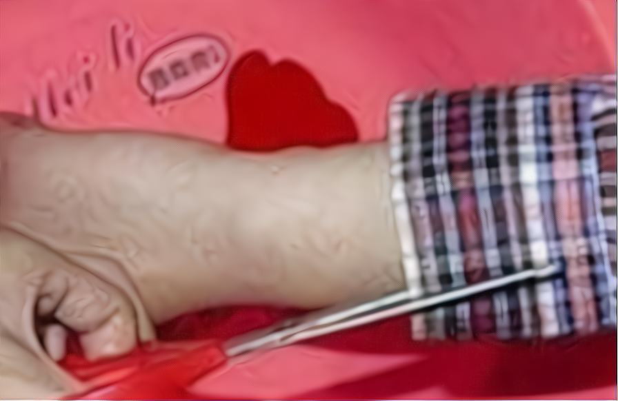 兜妈爱叨叨|孩子被沸水烫伤，家长需谨记五字诀救治，处理不当会害娃