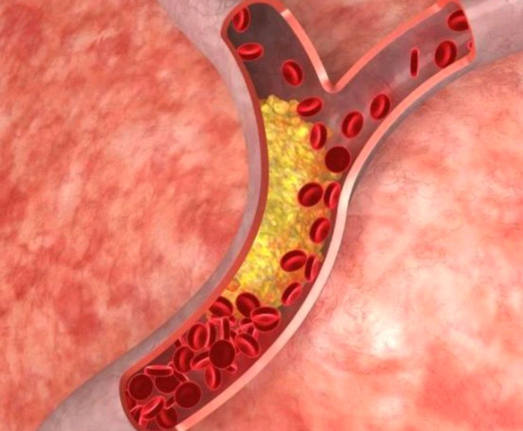 大脑|脑血管堵塞严重的人，早上起床可能有这3种迹象，尽早查一下脑CT