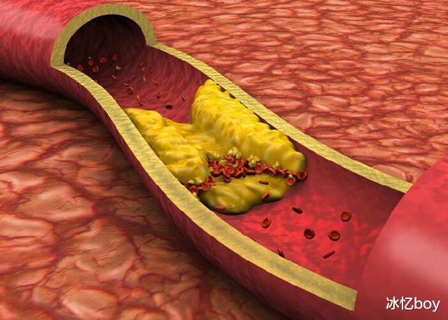 尿酸|痛风“源头”找到，不是高嘌呤食物，常吃1物，尿酸匀速降下