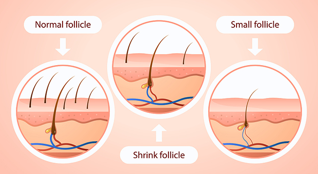 经络|谁说脂溢性脱发，没救了？