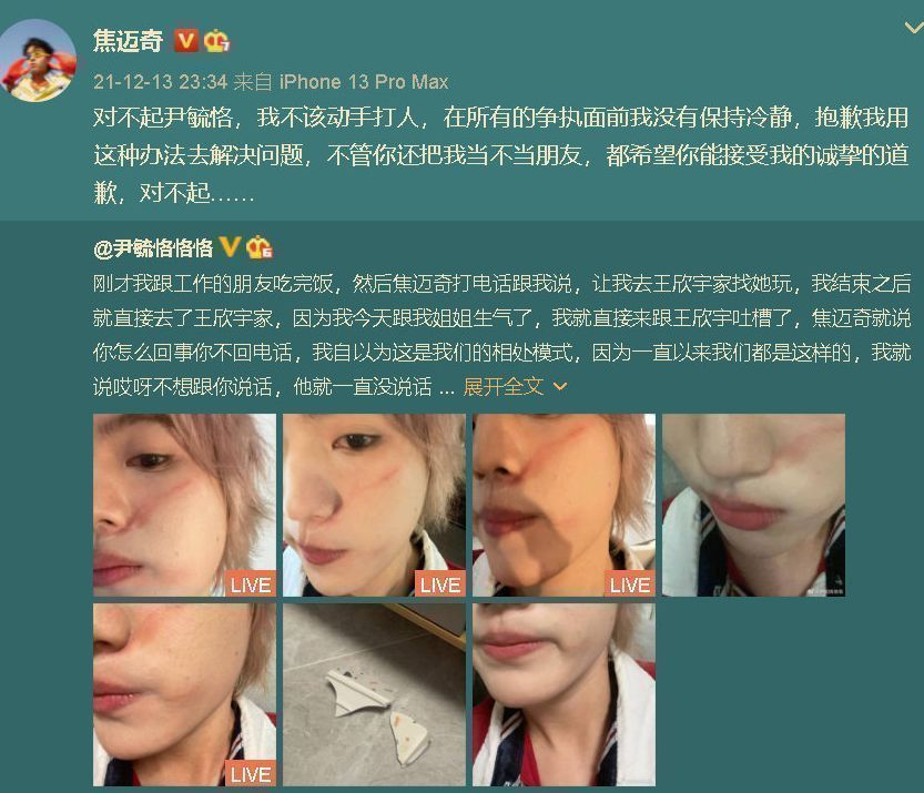 快乐男声|《快男》尹毓恪控诉焦迈奇打人，晒面部受伤照片，被误以为是女生