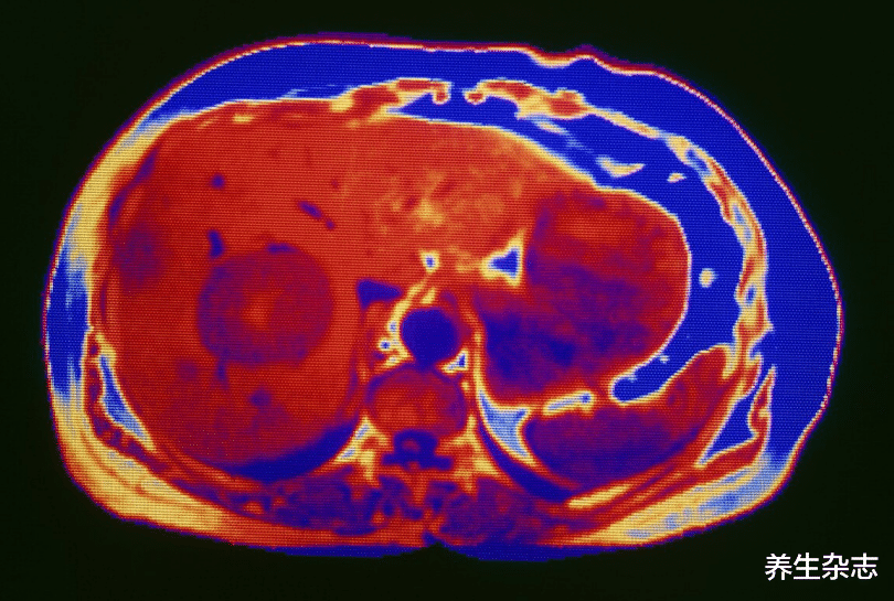 骨质疏松|每天一鸡蛋，18岁少女确诊肝癌，肝胆科主任：“1种鸡蛋”天天吃自毁肝脏