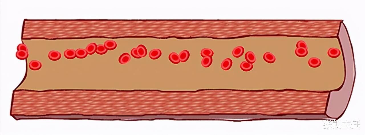 心脏|降血压出新药了:美阿沙坦钾!强效控压的同时,还保护心脏和肾脏