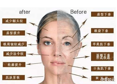 伊美如云|超声刀会加速皮肤衰老？这个锅它不背