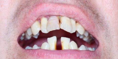 牙齿|牙齿松动怎么办?中西医理论有差异,中医:与“它”有关,学会1招,或可逃离拔牙