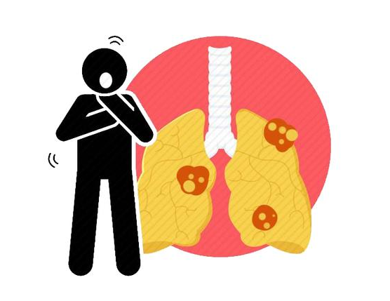肺癌|肺癌信号其实“写在脸上”：脸上有3个表现，别拖，尽快查肺CT！