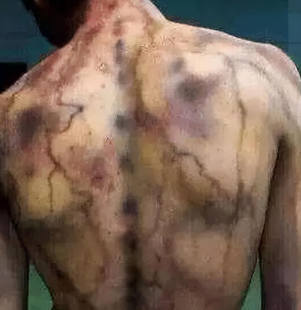 科学家 那些被闪电击中的人，科学家发现了一个共同的秘密