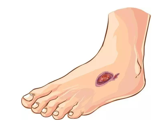 疾病|专家提醒：血糖偏高的人，双脚一般会有3种现象，不妨自查一下