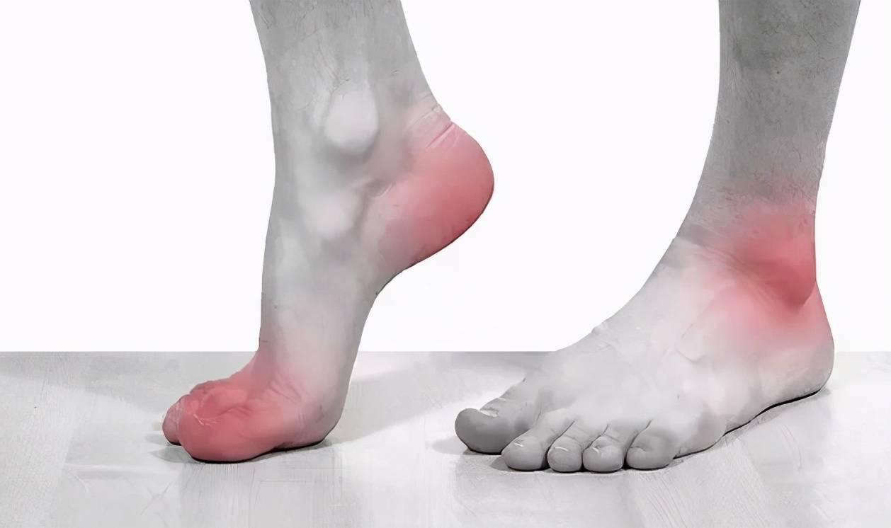 泊庭雪鹭西窗月|揭秘痛风：年纪轻轻，酒肉不沾，为什么也会英年早痛？