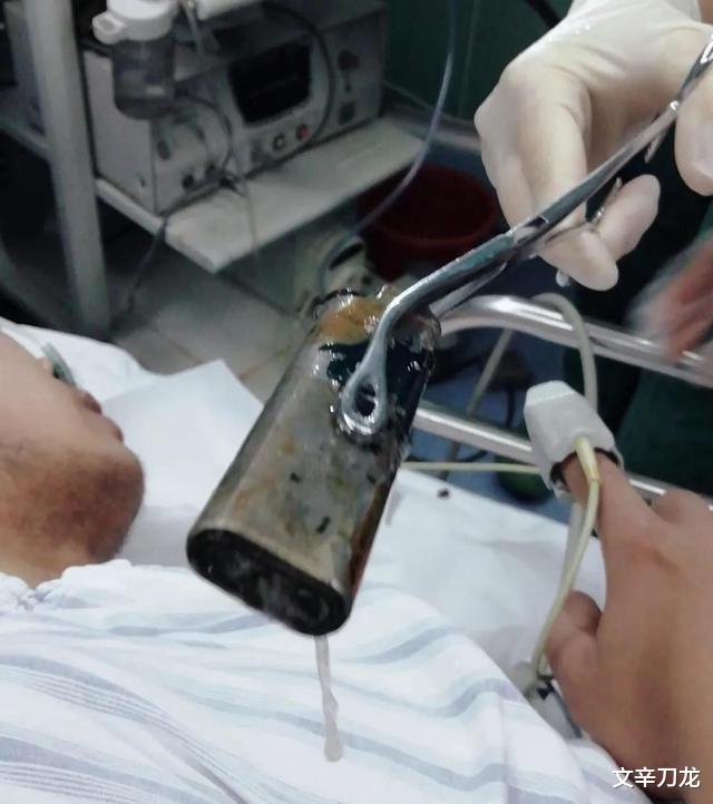 文辛刀龙 他的胃随时会爆炸！东莞35岁男子吞下打火机一周后安全取出