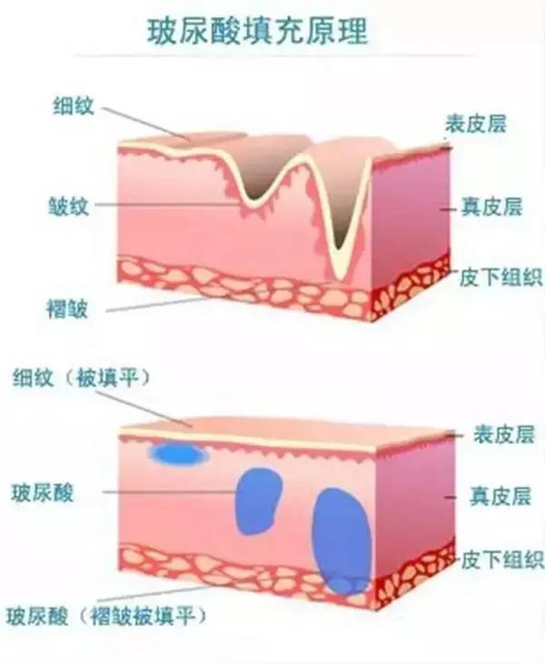 小美说美|停止打玻尿酸会更老吗