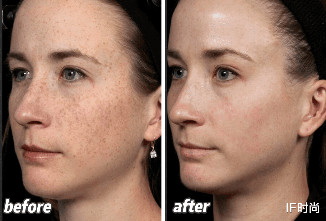 IF时尚|奥运选手也“换头”？快看这篇医美科普