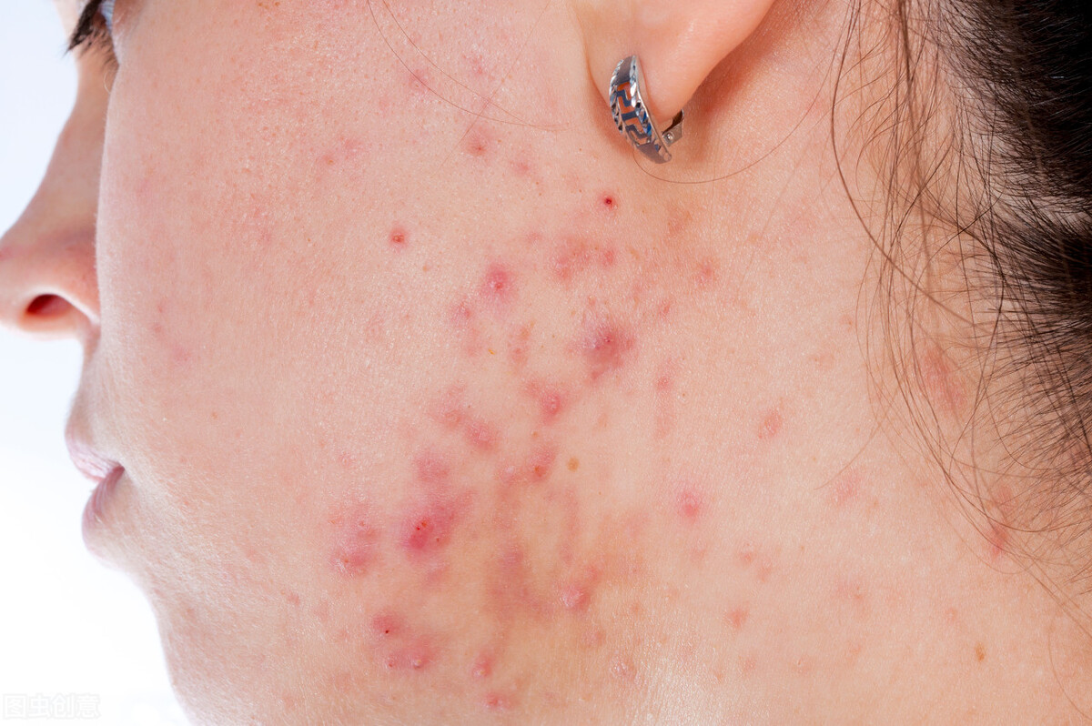 医生 玛恩医生 大油皮为什么越控越油?越来越“油腻”!