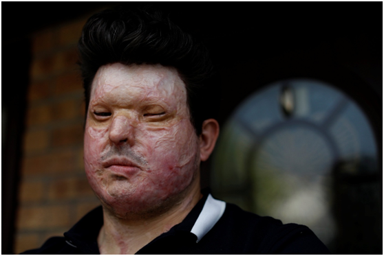 睹图 一家4口在家遭抢劫，男主人还被泼硫酸毁容，事后对方却说认错人